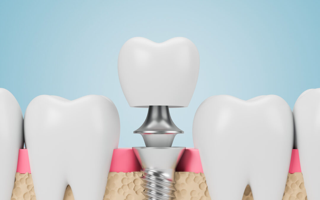 Dental Implants: Why Are They So Expensive?